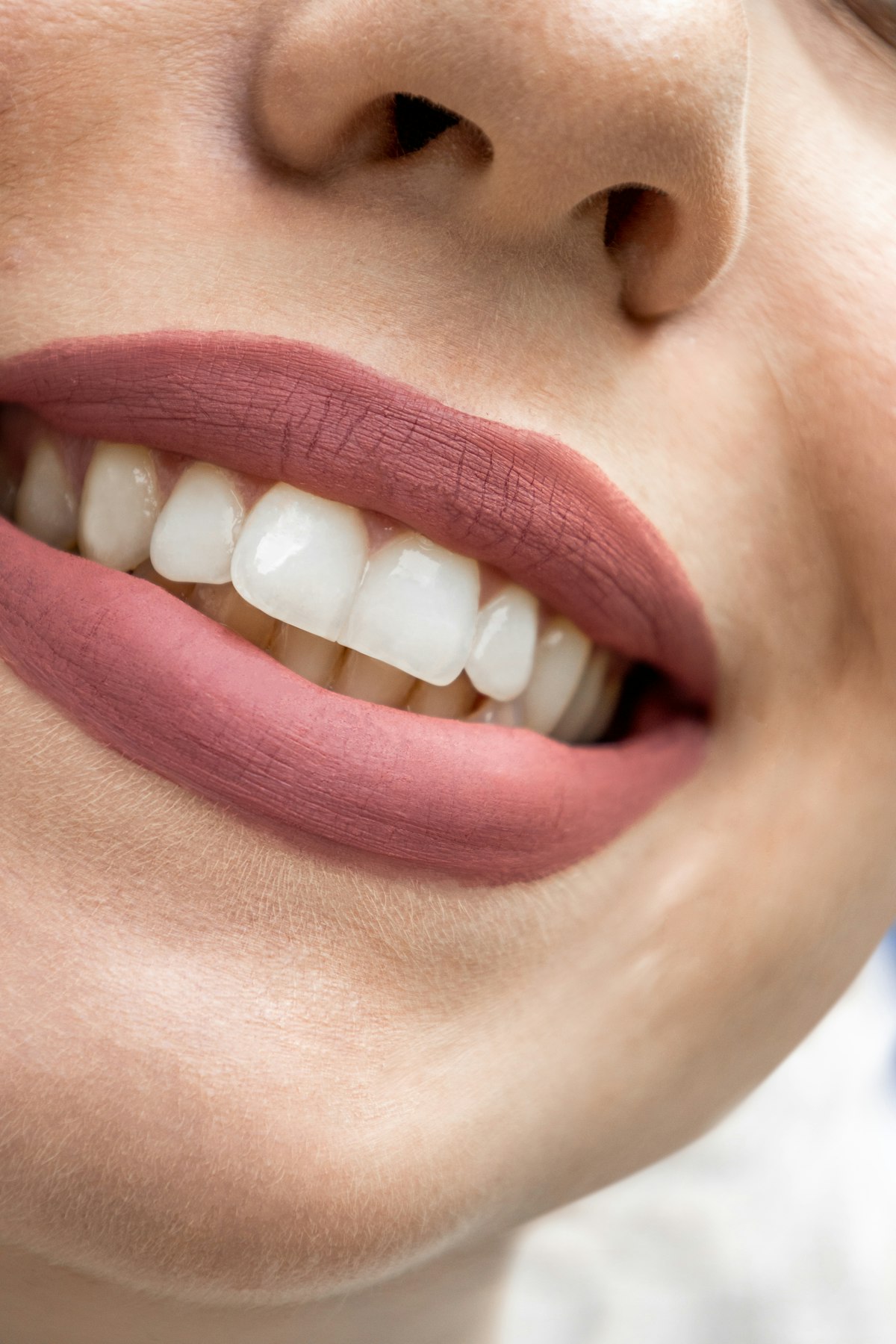 Diastema kapatma